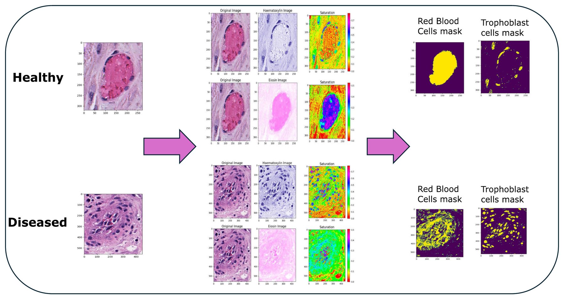 Figure 2A of the paper: a healthy and a diseased vessel, their stain deconvolution, and the resulting red-blood-cell and trophoblast masks