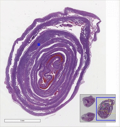 Automated model zooming into an annotated decidual vasculopathy detection on a whole-slide image